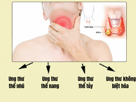 Dấu hiệu nhận biết và cách điều trị ung thư tuyến giáp